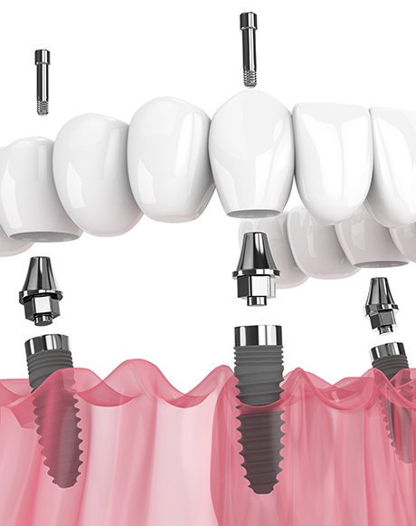 a 3D illustration of All-on-4 implants