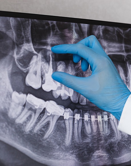 a closeup of a dentist examining a dental X-ray