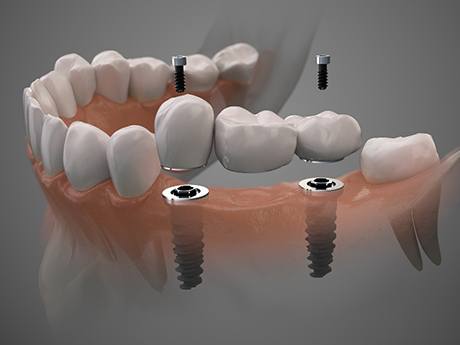 a computer illustration of an implant bridge