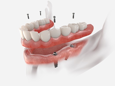 a computer illustration of an implant denture