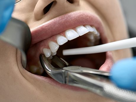 Closeup of forceps grasping a patient’s tooth