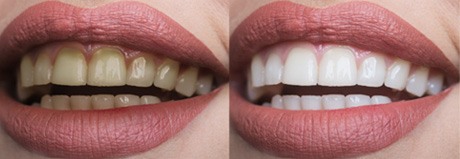 Before and after image of teeth whitening