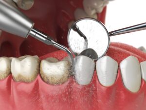 Close-up on animated image of dental tools cleaning teeth.